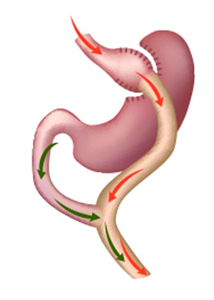 Mini-Gastric Bypass