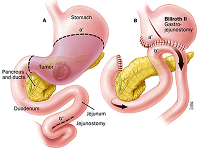Mini-Gastric Bypass