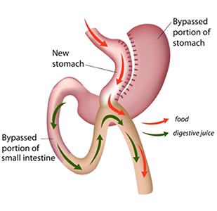 Mini-Gastric Bypass